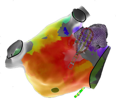 A Palermo arriva il Cuore in 3D: il primo nel Sud Italia contro le aritmie complesse